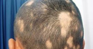female hair loss treatment - ALOPECIA AREATA
